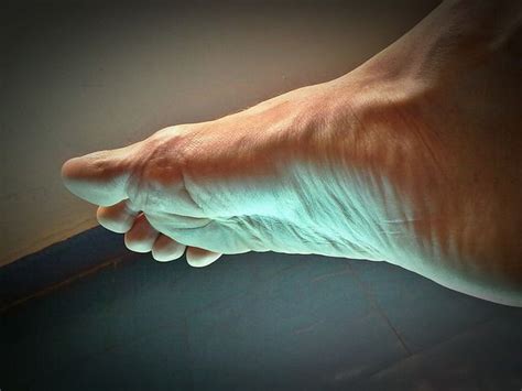 hallux limitus ottawa foot clinic