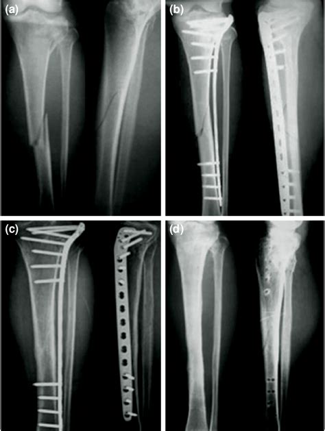 Patient Treated With Minimally Invasive Plate Osteosynthesis A