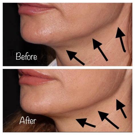 Nefertiti Lift Reduce Jowls And Contour Your Jawline With Botox