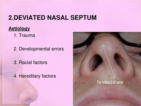 Ppt Nasal Septal Diseases Powerpoint Presentation Free Download Id