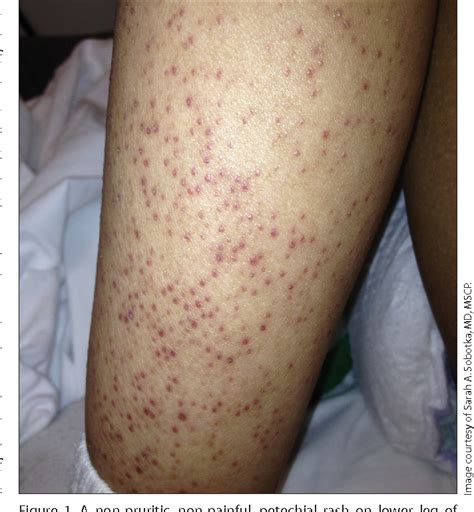 Figure 1 From Petechial Rash In A Child With Autism And Trisomy 21