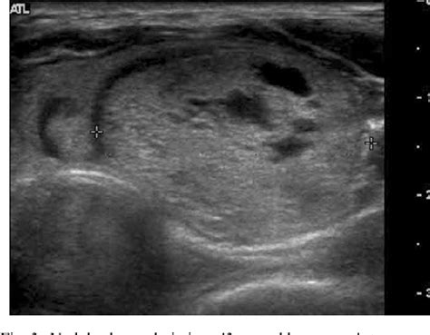 Table 1 From Are There Any Specific Ultrasound Findings Of Nodular