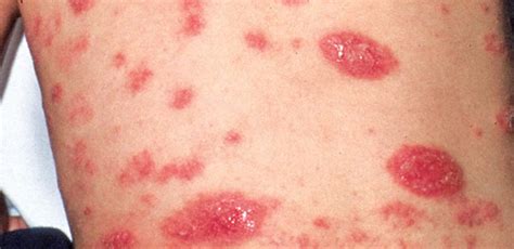 Discoid Eczema In Pictures How To Treat