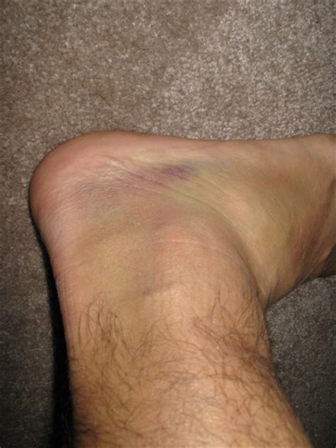 Ankle Sprains Bone Bruises And The Long Road Back