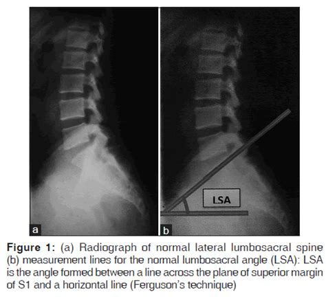 It is important to be aware that some. Measurement of Lumbosacral Angle in Normal Radiographs: A ...