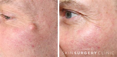 Cyst Removal From £395 Leeds Bradford Skin Surgery Clinic