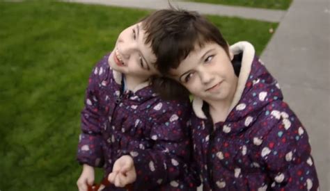 Conjoined Twins Who Share A Brain Hear Each Others Thoughts Goodfullness