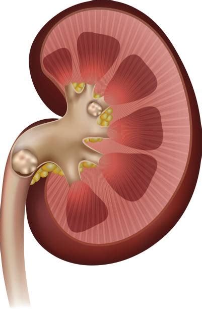 Kidney Stone Clip Art Vector Images And Illustrations Istock