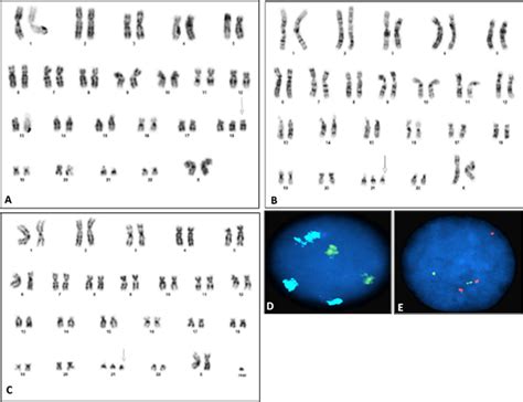 Gtg Banded Karyotype At Birth Showing A Trisomy 18 B Trisomy 21 And C Download Scientific