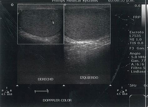 Ultrasonido Doppler Que Compara Flujo Vascular En Ambos Test Culos