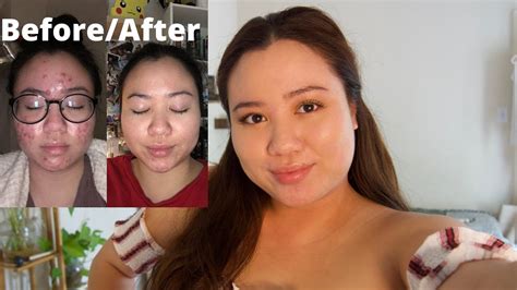 How I Cleared My Cystic Acne NO Accutane Clear Acne Naturally What Caused My Acne YouTube