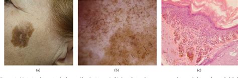 Figure 2 From Dermoscopic Features Of Facial Pigmented Skin Lesions