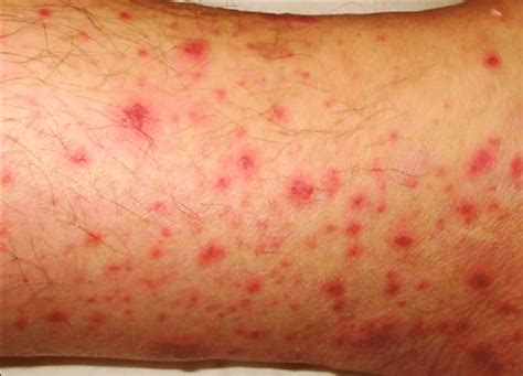 Maculopapular Rash Causes Treatment And Pictures Worl