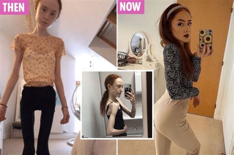 Skinny Anorexic Girls Porn