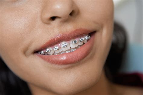 Modern cosmetic dentistry techniques mean you don't have to have your healthy teeth reshaped or go through tooth extraction in order to fit the veneers. Overbite Braces: How They Work