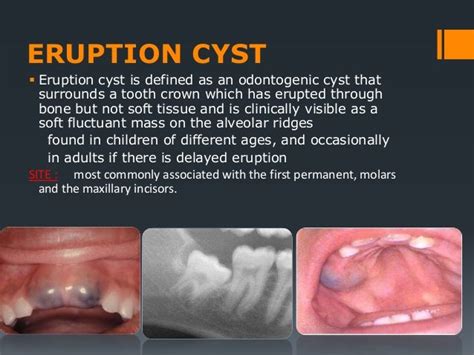 Cysts Of Oral Regions