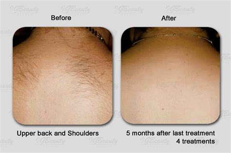 Best Laser Hair Removal Laser Clinic Toronto Igbeauty