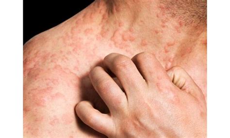 Nemolizumab Beats Placebo For Reduction Of Pruritus In Eczema