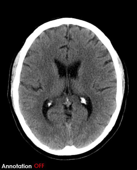 Ventricles Of The Brain Ct Sharedoc