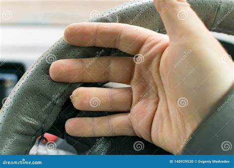 Hand Of A Man With A Missing Finger Phalanx Stock Photo Image Of