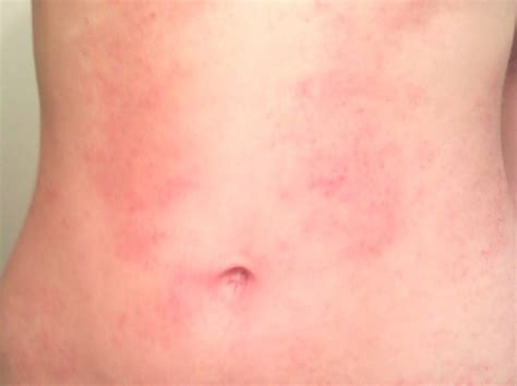 If you find rashes on your body more than 2 days consult any physician. Belly button rash - causes, treatment, pictures