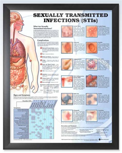 sexually transmitted infections anatomy posters clinicalposters