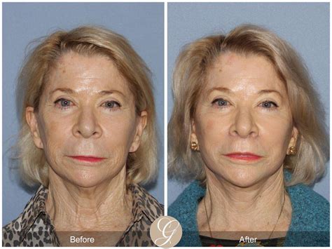 Facelift Seventies Before After Photos Patient Dr Kevin Sadati