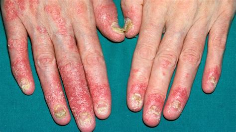 Psoriasis And Psoriatic Arthritis Whats The Link
