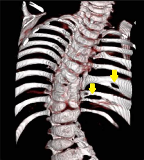 Cureus Anatomical Variations That Can Lead To Spine Surgery At The