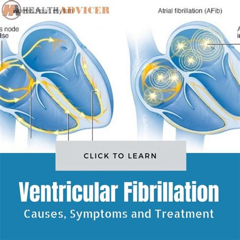 Ventricular Fibrillation Causes Picture Symptoms And Treatment