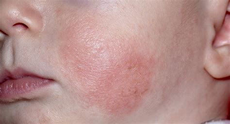 Baby Eczema Causes Symptoms Treatments And Creams Babycentre Uk
