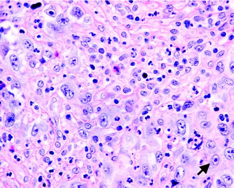 Primary Mediastinal Large B‐cell Lymphoma Savage 2006 The
