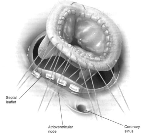 Tricuspid Valve Replacement Operative Techniques In Thoracic And
