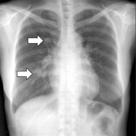 A Sixth Month Follow Up Simple Chest Radiography And B Chest