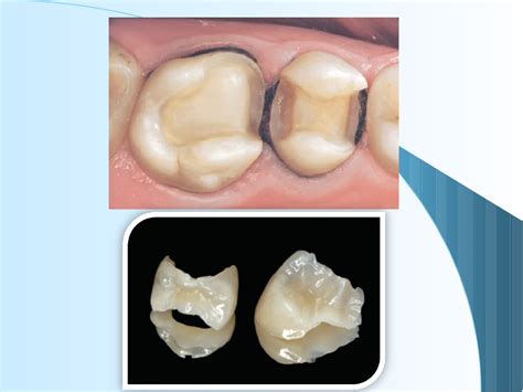 6restoration Of The Endodontically Treated Tooth