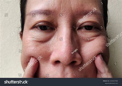Portrait Showing Flabbiness Adipose Sagging Skin Stock Photo 2195427565