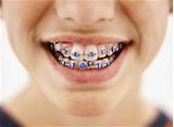 How Much Braces Cost With Insurance Images