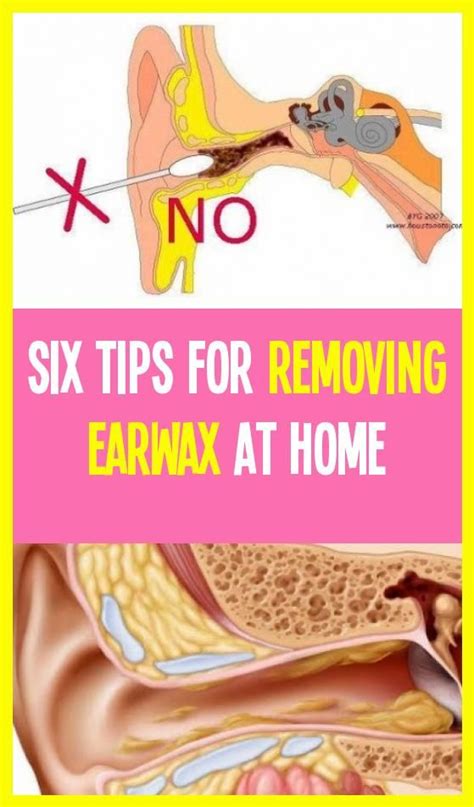 6 Tips For Earwax Removal Home Earcanal Innerear In 2020 Ear Wax