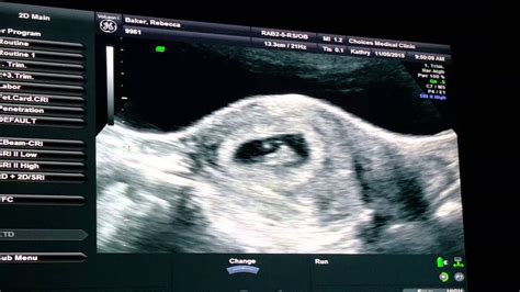 And we offer you to check them out without further ado if you want to know what to expect in the first month of a relationship. 7 Week Ultrasound | BOY - YouTube
