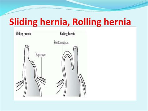 Sliding Vs Rolling Hernia