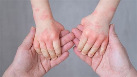 Rashes In Kids Age By Age Skin Condition Guide Todays Parent
