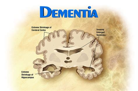 Vascular dementia may be caused by brain damage from strokes, atherosclerosis, endocarditis, or because vascular dementia is caused by the death of brain tissue and atherosclerosis, there is no. Distinguishing Alzheimer's Disease from Other Types of ...
