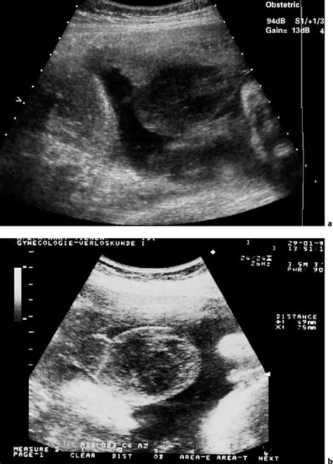 Figure 1 From Prenatal Diagnosis Of A Subamniotic Hematoma Semantic