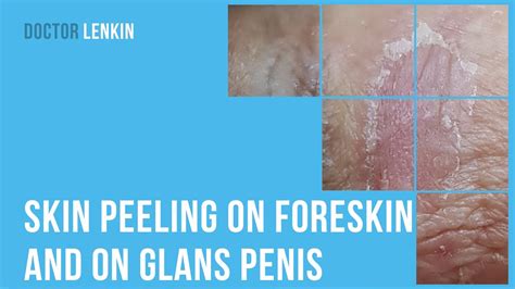 Skin Peeling On Foreskin And On Glans Penis Youtube
