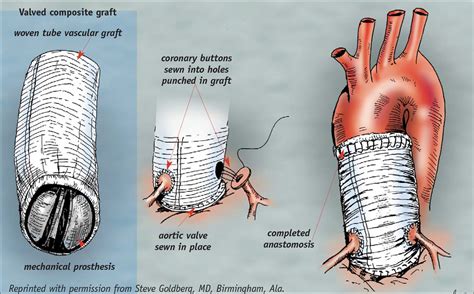 The Modified Bentall Procedure For Aortic Root Replacement Cherry