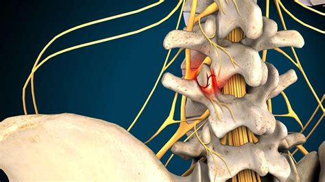 Facet Joint Syndrome Causes Symptoms And Treatment Disc