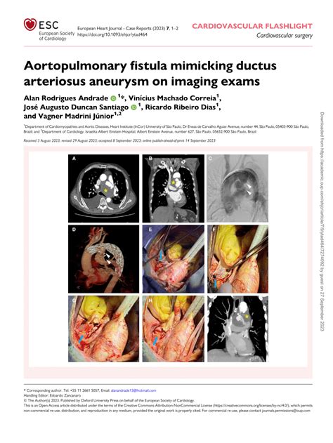 PDF Aortopulmonary Fistula Mimicking Ductus Arteriosus Aneurysm On