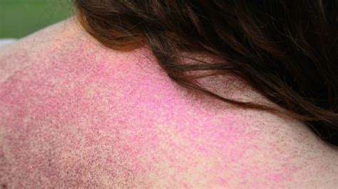 Woman With Chronic Idiopathic Urticaria Shares Skin Rash Photos Allure