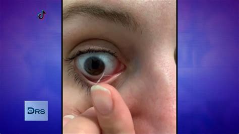 Stringy Eye Discharge