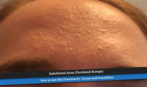 Subclinical Acne On Forehead How To Get Rid Treatment And Causes
